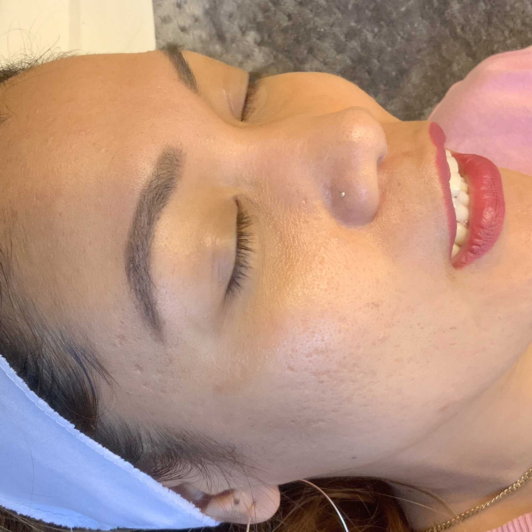 An After photo of a microneedling procedure in Seattle and Tacoma