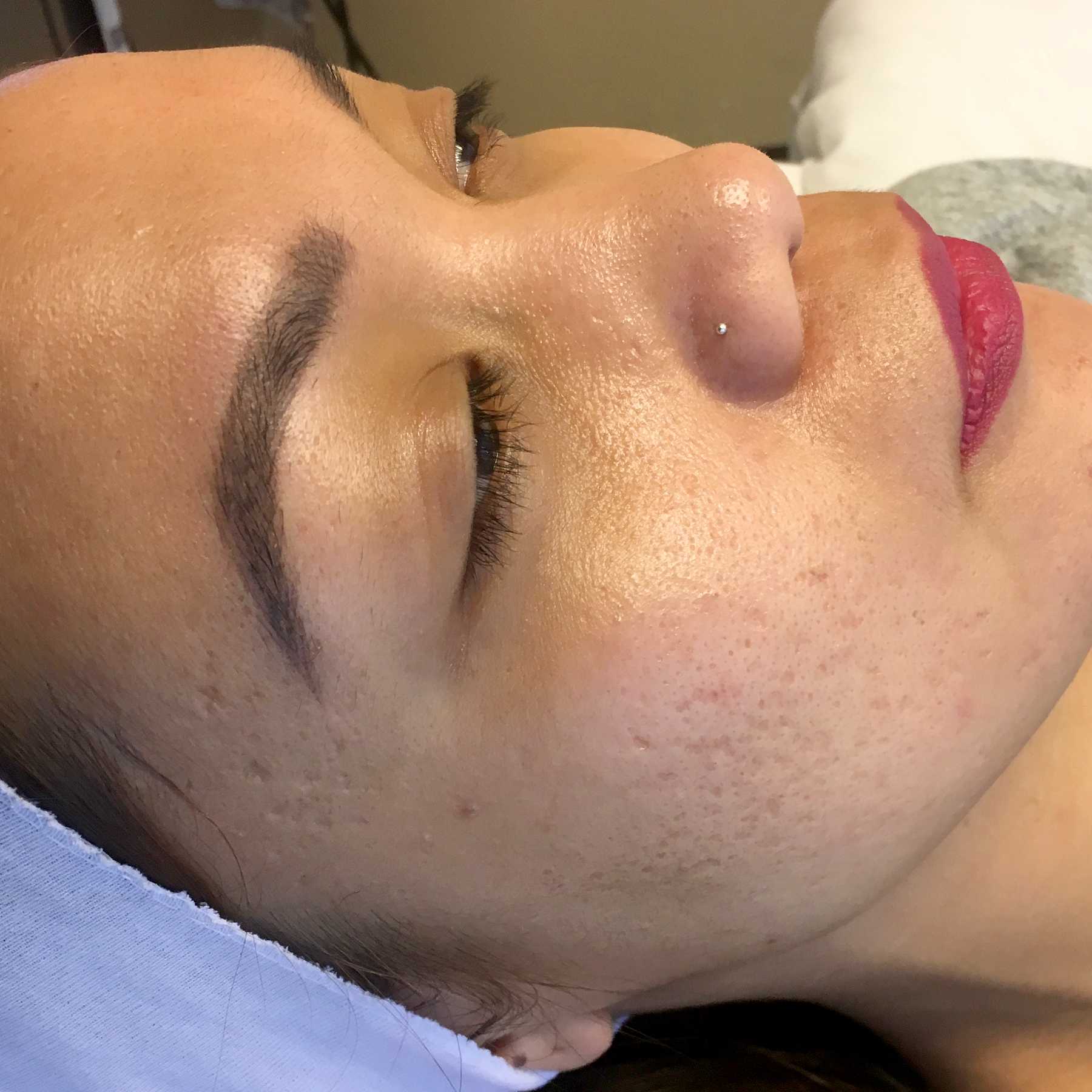 A Before photo of a microneedling procedure in Seattle and Tacoma