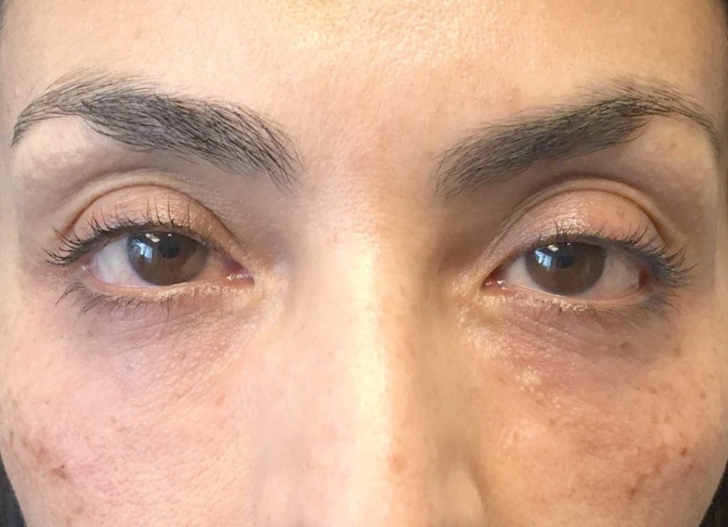 An After photo of Tear Trough filler in Seattle and Tacoma