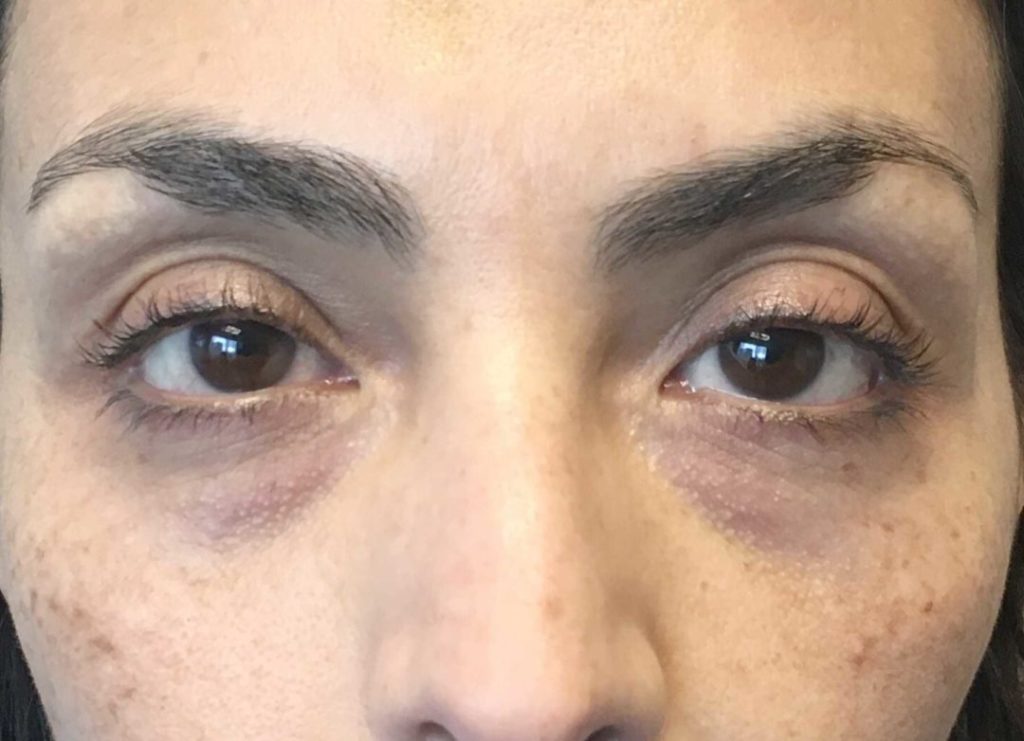 A Before photo of Tear Trough Filler in Seattle and Tacoma