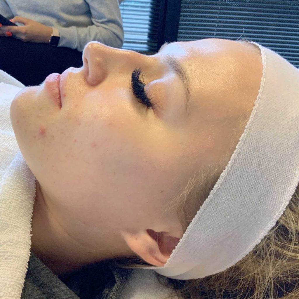 A Before photo of a Chemical Peel procedure by Master Estheticians in Seattle and Tacoma