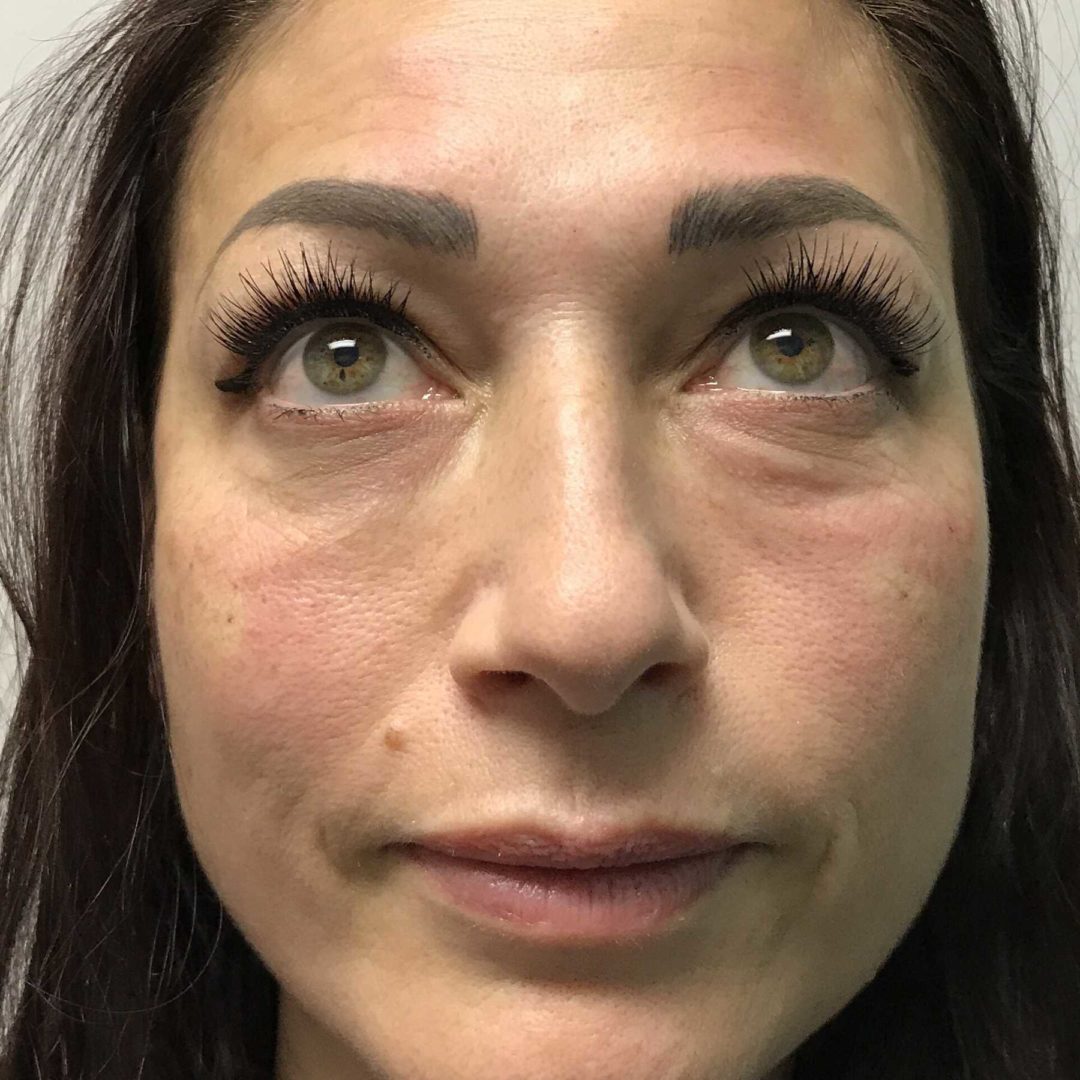 An After photo of Tear Trough Filler in Seattle and Tacoma