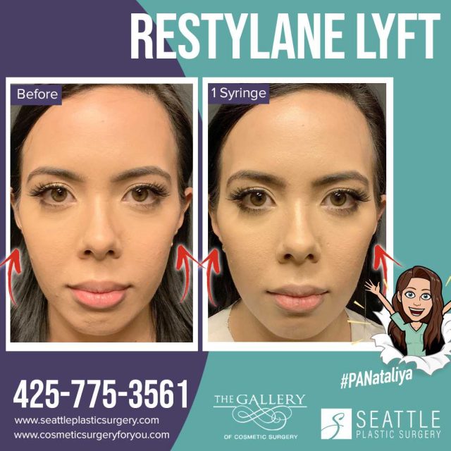 An Instagram Before and After of cheek filler by PA Nataliya in Seattle and Tacoma