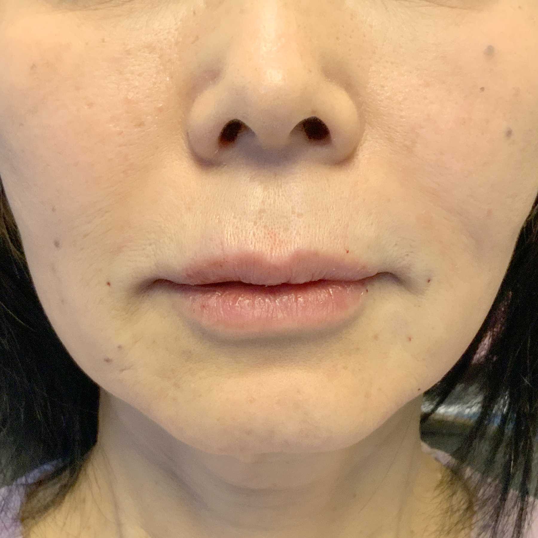 An After photo of Restylane Defyne Nasolabial Fold Filler by Injector Nataliya in Seattle and Tacoma