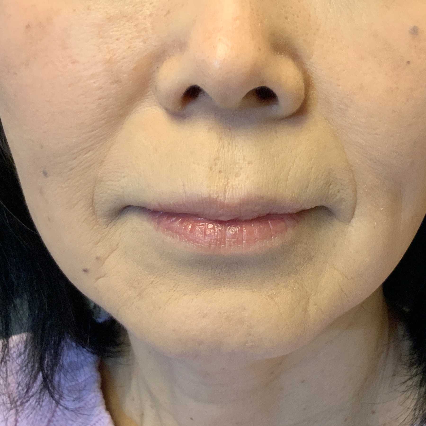 A Before photo of Restylane Defyne Nasolabial Fold Filler by Injector Nataliya in Seattle and Tacoma