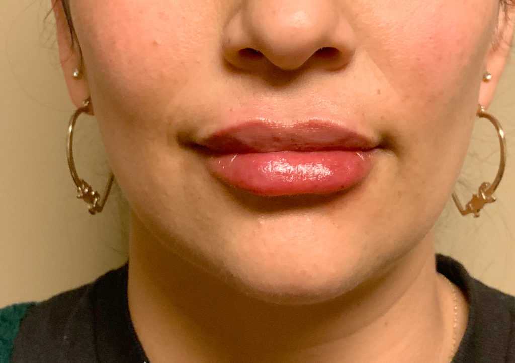 An After photo of Restylane Defyne lip filler by Injector Gyna in Seattle and Tacoma