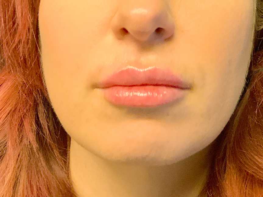 An After photo of Restylane L Lip Filler Injections In Seattle and Tacoma