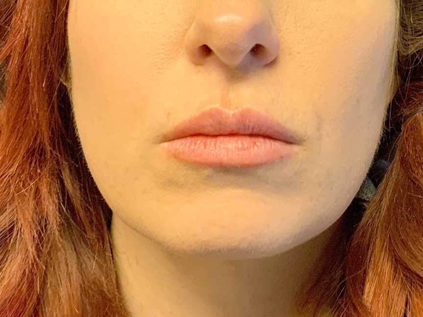 A Before photo of Restylane L Lip Filler Injections In Seattle and Tacoma