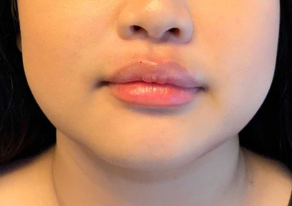 An photo of Restylane L Lip Filler by Injector Gyna in Seattle and Tacoma