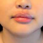 An photo of Restylane L Lip Filler by Injector Gyna in Seattle and Tacoma