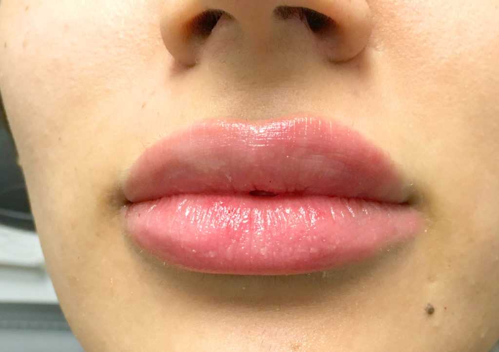 An After photo of Restylane Defyne Lip Filler in Seattle and Tacoma