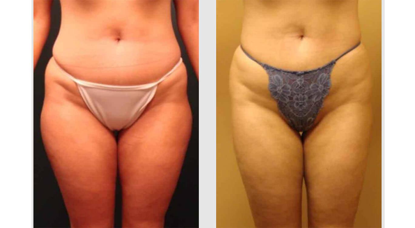 A Before and After photo of a Brazilian Butt Lift Plastic Surgery by Dr. Craig Jonov in Seattle and Tacoma