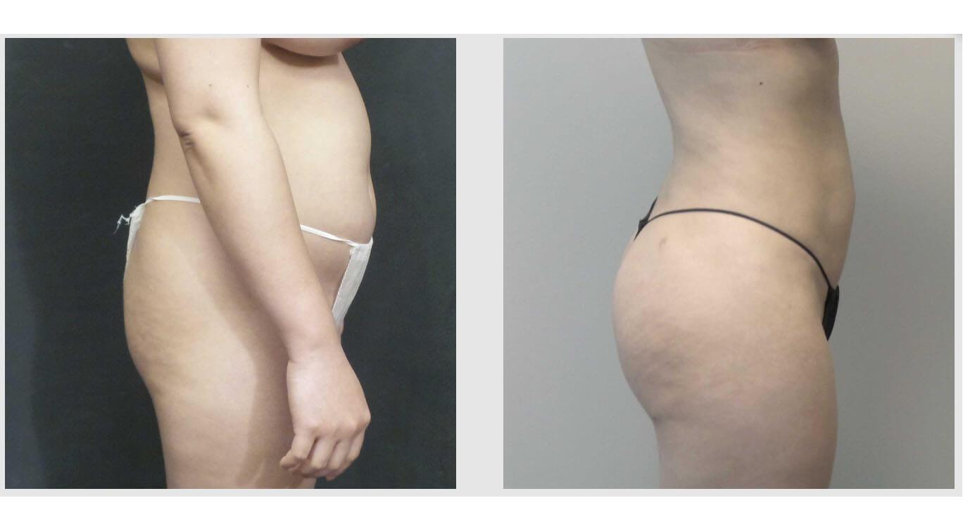 A Before and After photo of a Brazilian Butt Lift Plastic Surgery by Dr. Craig Jonov in Seattle and Tacoma