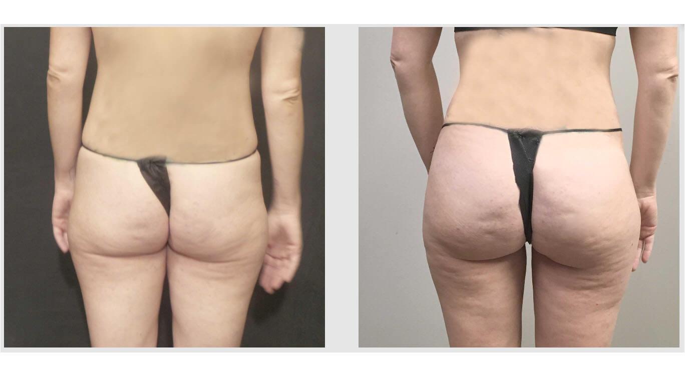 A Before and After photo of a Brazilian Butt Lift Plastic Surgery by Dr. Craig Jonov in Seattle and Tacoma