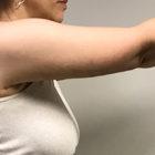 An After Photo of an Arm Lift Plastic Surgery by Dr. Craig Jonov in Seattle and Tacoma