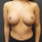 An After photo of a Breast Augmentation Plastic Surgery by Dr. Craig Jonov in Seattle and Tacoma