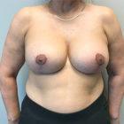 An After Photo of a Breast Revision Plastic Surgery by Dr. Craig Jonov in Seattle and Tacoma
