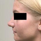 An After Photo of a Rhinoplasty Plastic Surgery by Dr. Craig Jonov in Seattle and Tacoma