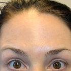 An After Photo of Dysport Injections in Seattle and Tacoma at Seattle Plastic Surgery