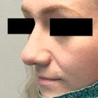 An After photo of a Rhinoplasty Plastic Surgery by Dr. David Santos in Seattle and Tacoma