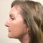 An After photo of a Facelift Plastic Surgery by Dr. David Santos in Seattle and Tacoma