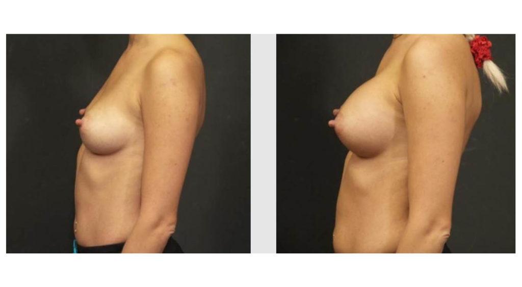 A Before and After photo of a Breast Augmentation Plastic Surgery by Dr. Craig Jonov in Seattle and Tacoma