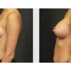 A Before and After photo of a Breast Augmentation Plastic Surgery by Dr. Craig Jonov in Seattle and Tacoma