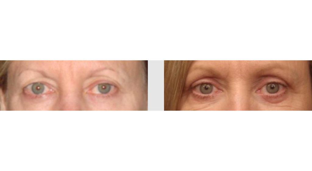 A Before and After photo of an Eyelid Lift Plastic Surgery by Dr. Craig Jonov in Seattle and Tacoma