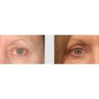 A Before and After photo of an Eyelid Lift Plastic Surgery by Dr. Craig Jonov in Seattle and Tacoma