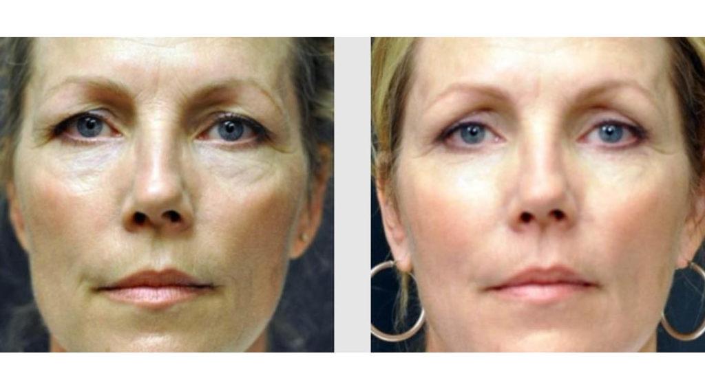 A Before and After photo of a Facelift Plastic Surgery by Dr. Craig Jonov in Seattle and Tacoma