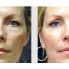 A Before and After photo of a Facelift Plastic Surgery by Dr. Craig Jonov in Seattle and Tacoma