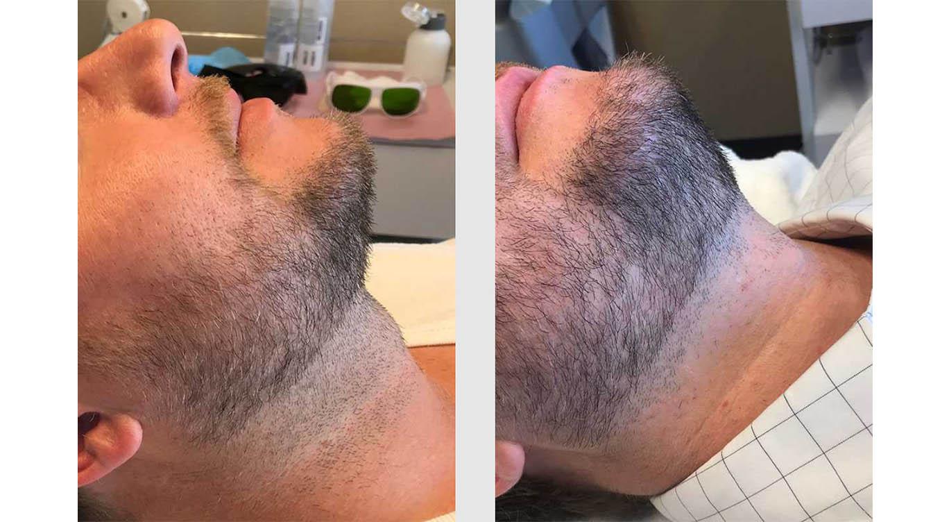 A Before and After photo of Laser Hair Removal by Master Estheticians in Seattle and Tacoma