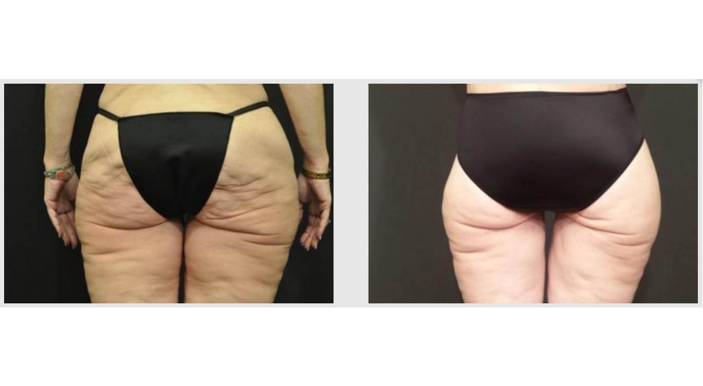 A Before and After photo of a Lower Body Lift Plastic Surgery by Dr. Craig Jonov in Seattle and Tacoma