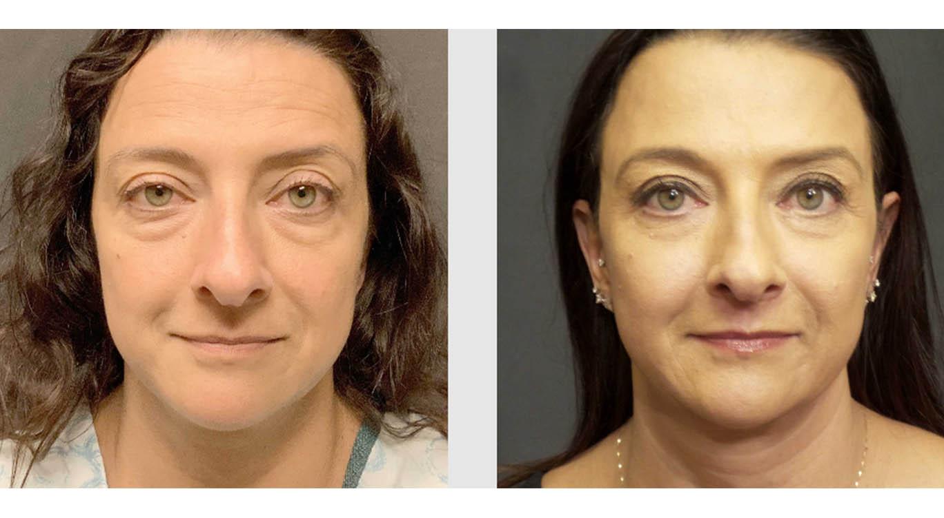 A Before and After photo of a Mid Facelift Plastic Surgery by Dr. Craig Jonov in Seattle and Tacoma