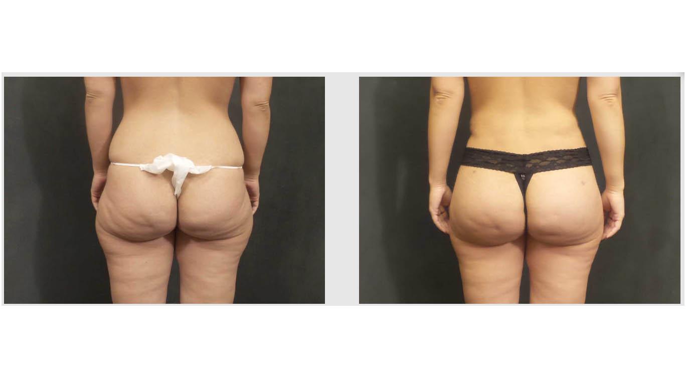 A Before and After photo of a Non-Surgical Brazilian Butt Lift by Dr. Craig Jonov in Seattle and Tacoma