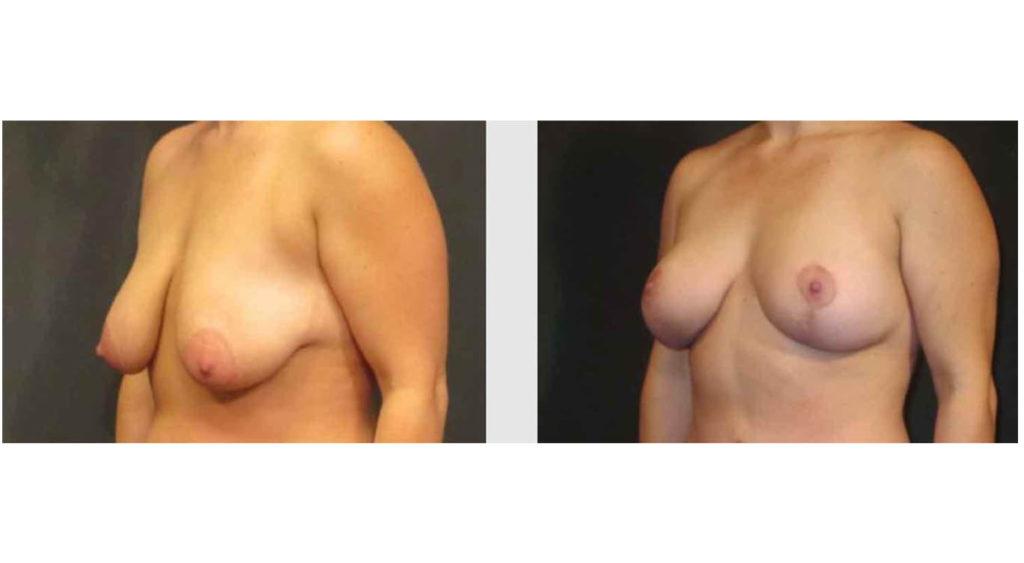A Before and After photo of a Breast Lift Plastic Surgery by Dr. Craig Jonov in Seattle and Tacoma