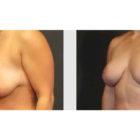 A Before and After photo of a Breast Lift Plastic Surgery by Dr. Craig Jonov in Seattle and Tacoma