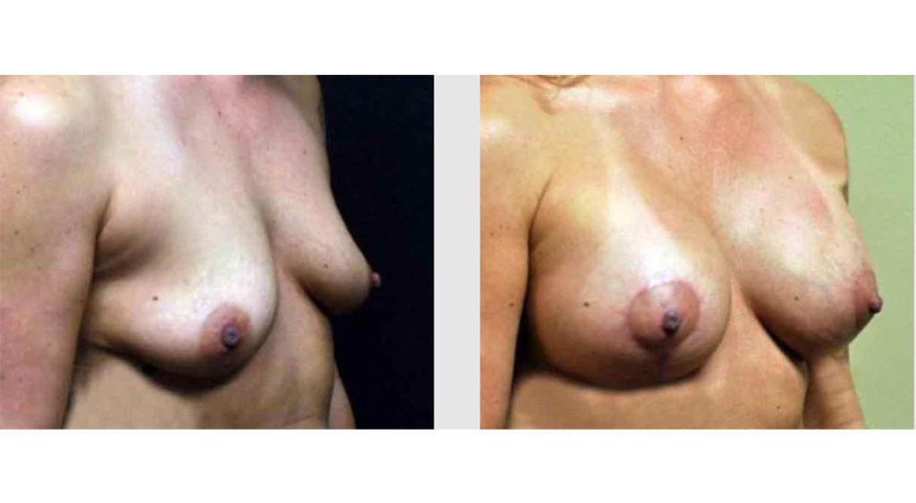 A Before and After photo of a Breast Lift Plastic Surgery by Dr. Craig Jonov in Seattle and Tacoma