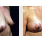 A Before and After photo of a Breast Lift Plastic Surgery by Dr. Craig Jonov in Seattle and Tacoma