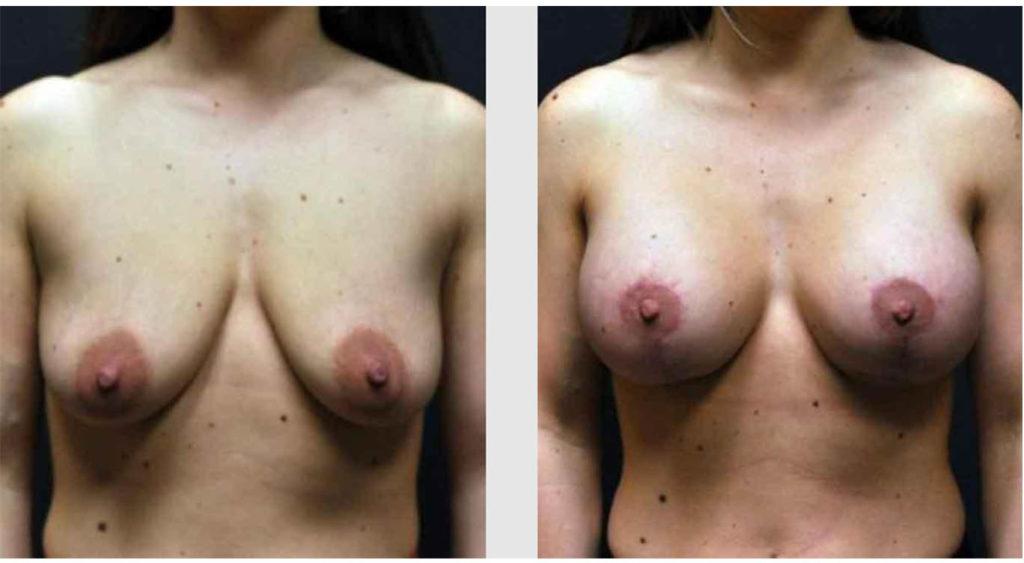 A Before and After photo of a Breast Lift Plastic Surgery by Dr. Craig Jonov in Seattle and Tacoma