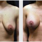 A Before and After photo of a Breast Lift Plastic Surgery by Dr. Craig Jonov in Seattle and Tacoma