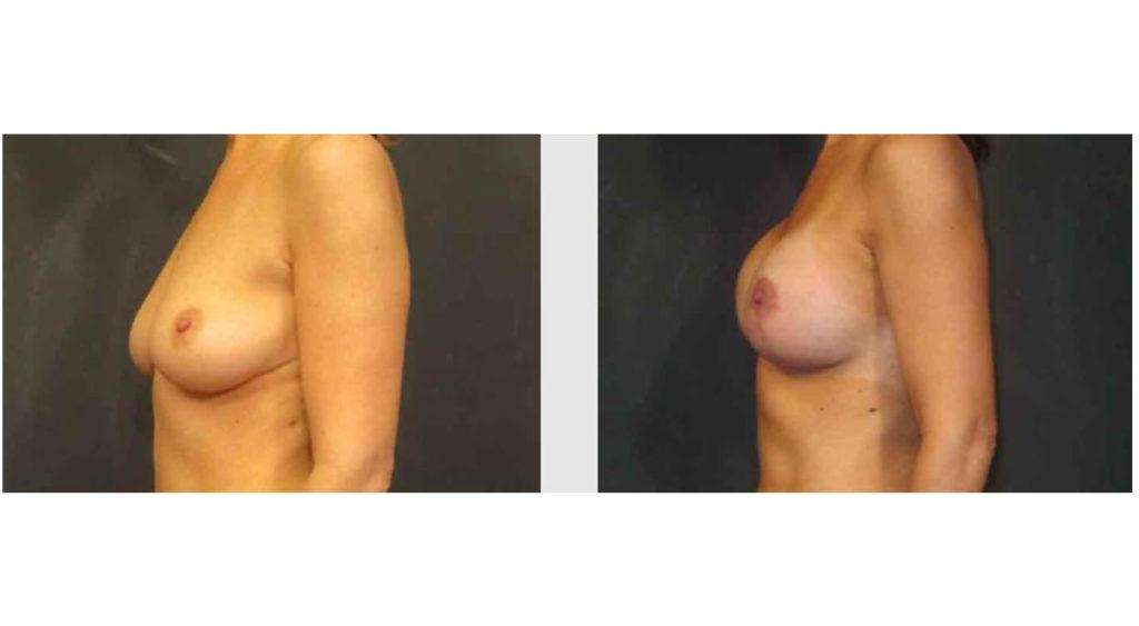 A Before and After photo of a Breast Lift Plastic Surgery by Dr. Craig Jonov in Seattle and Tacoma