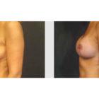 A Before and After photo of a Breast Lift Plastic Surgery by Dr. Craig Jonov in Seattle and Tacoma