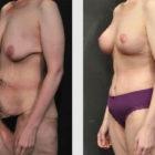 A Before and After photo of a Breast Lift Plastic Surgery by Dr. Craig Jonov in Seattle and Tacoma