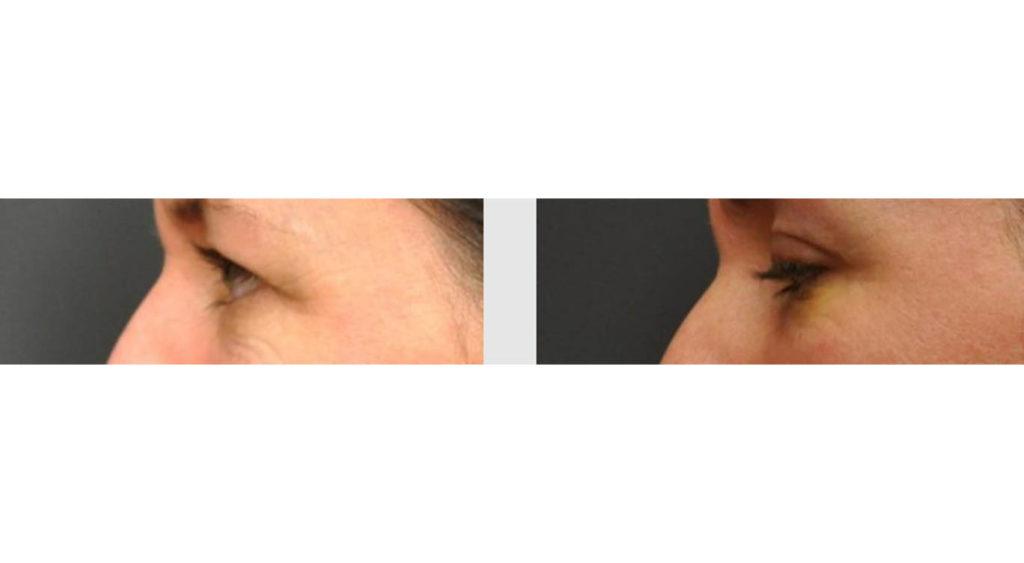 A Before and After photo of an Eyelid Lift Plastic Surgery by Dr. Craig Jonov in Seattle and Tacoma