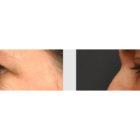 A Before and After photo of an Eyelid Lift Plastic Surgery by Dr. Craig Jonov in Seattle and Tacoma