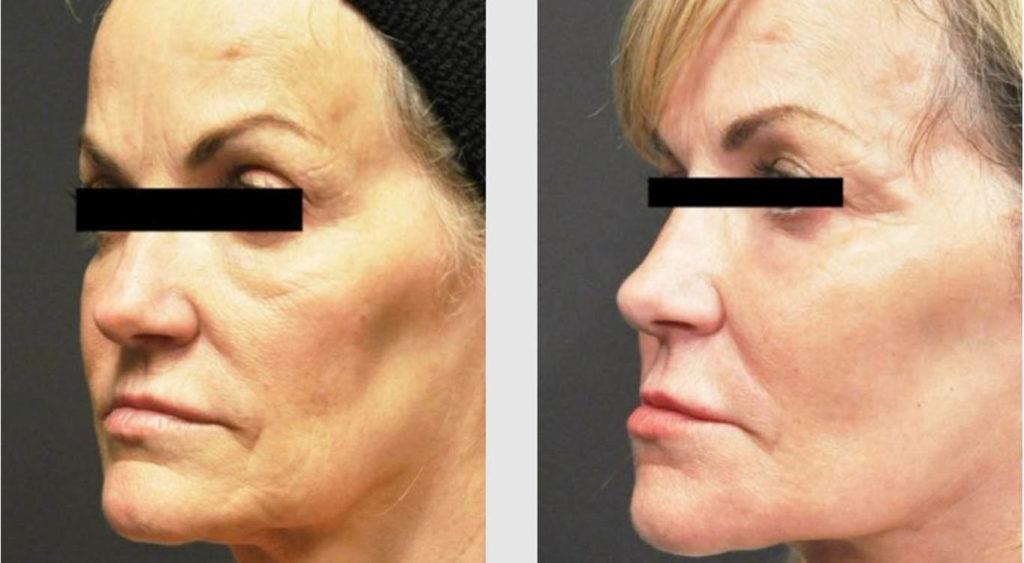 A Before and After photo of an Eyelid Lift Plastic Surgery by Dr. Craig Jonov in Seattle and Tacoma