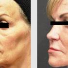 A Before and After photo of an Eyelid Lift Plastic Surgery by Dr. Craig Jonov in Seattle and Tacoma