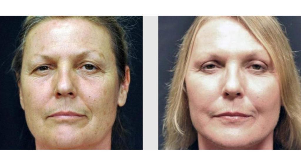 A Before and After photo of an Eyelid Lift Plastic Surgery by Dr. Craig Jonov in Seattle and Tacoma
