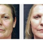 A Before and After photo of an Eyelid Lift Plastic Surgery by Dr. Craig Jonov in Seattle and Tacoma